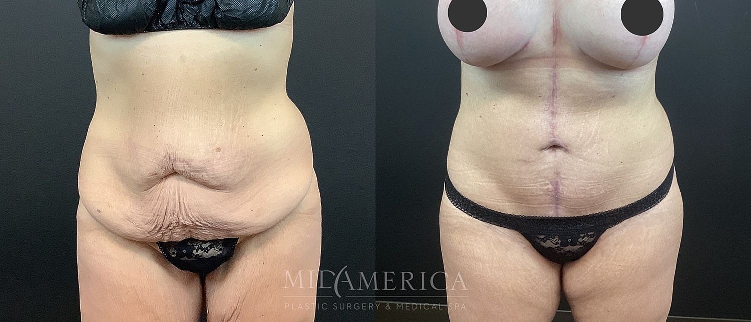 Before and after body contouring surgery comparison.