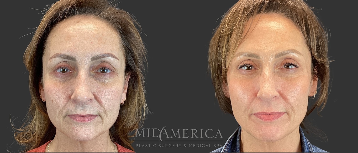 Sculptra Before & After