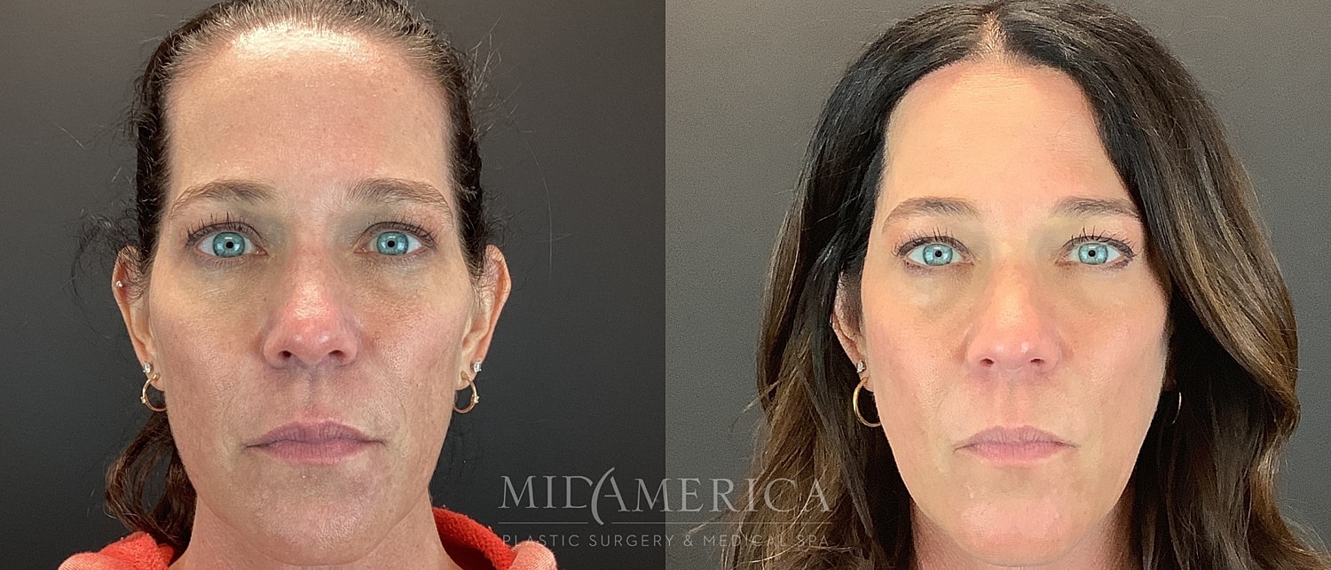 Sculptra Before & After