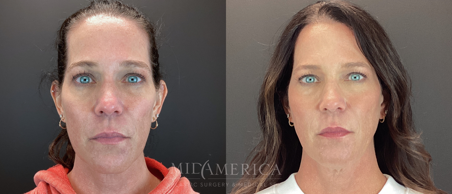 Sculptra Before & After