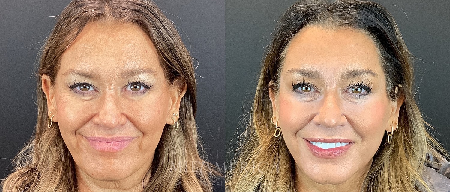 Sculptra Before & After
