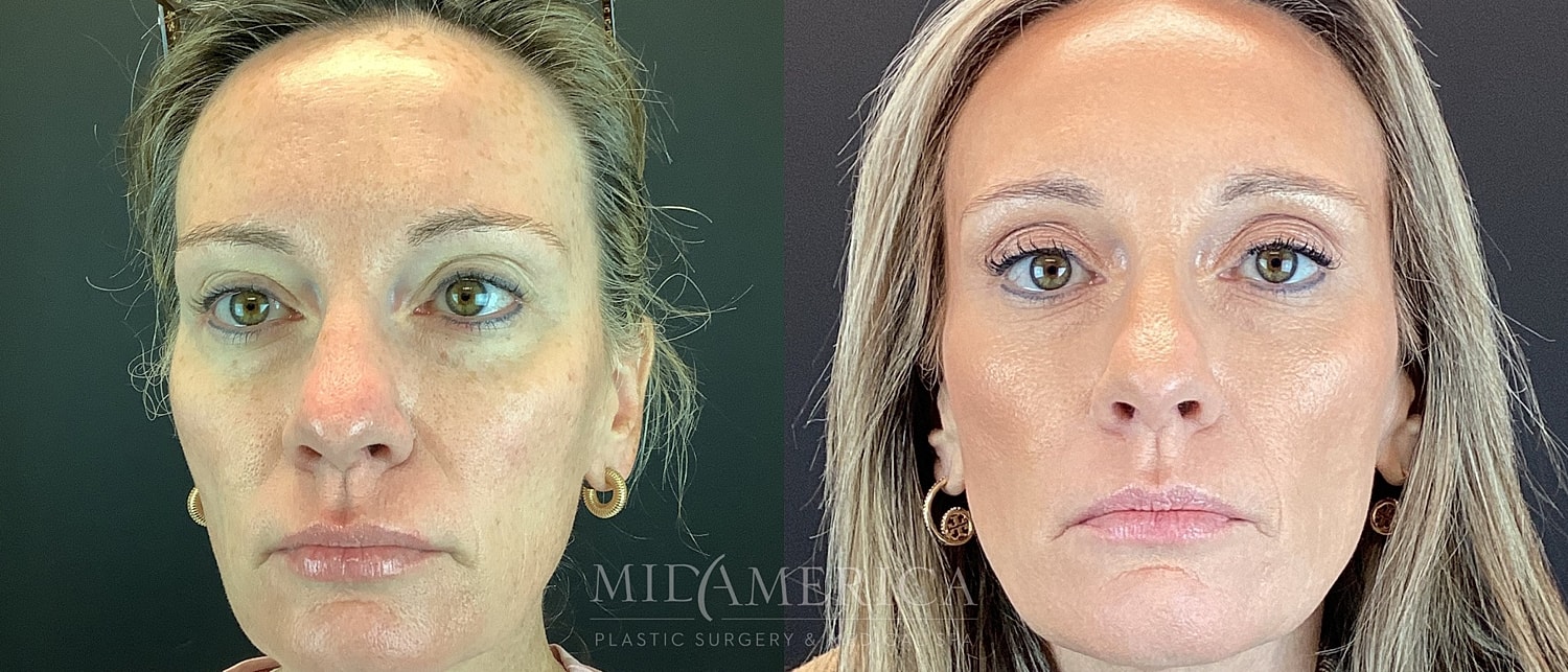 Sculptra Before & After