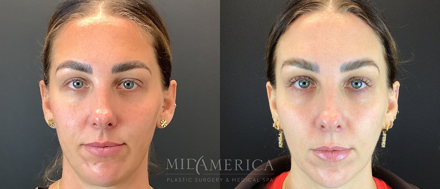 Sculptra Before & After