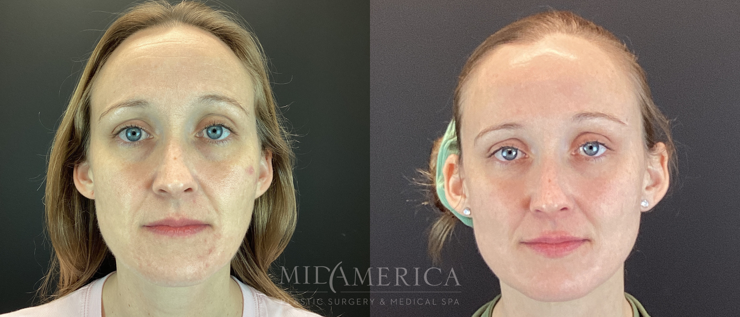Sculptra Before & After