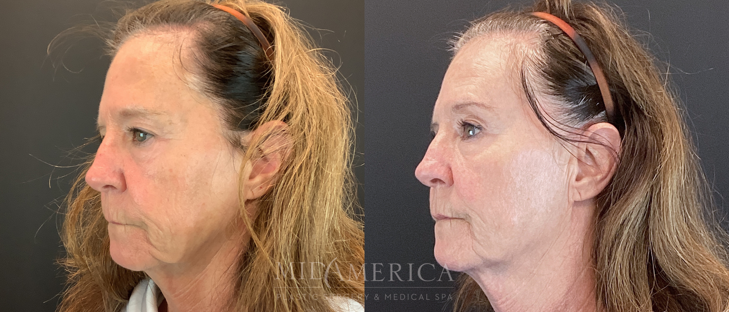 Sculptra Before & After