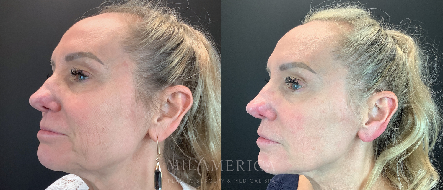 Sculptra Before & After