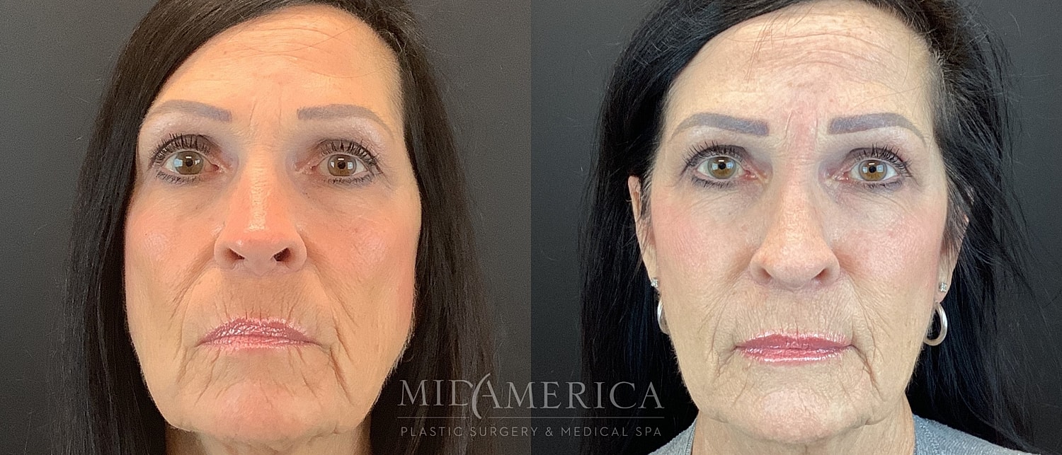 Sculptra Before & After