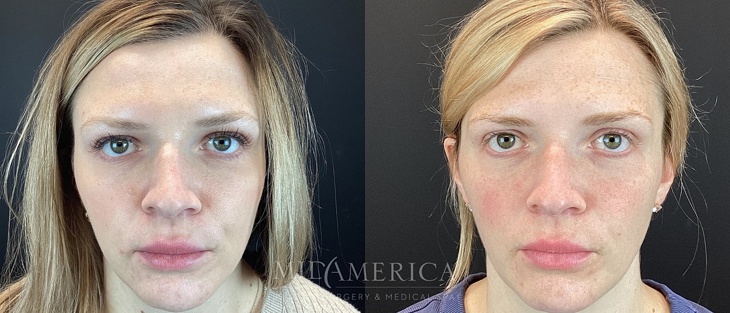 Sculptra Before & After