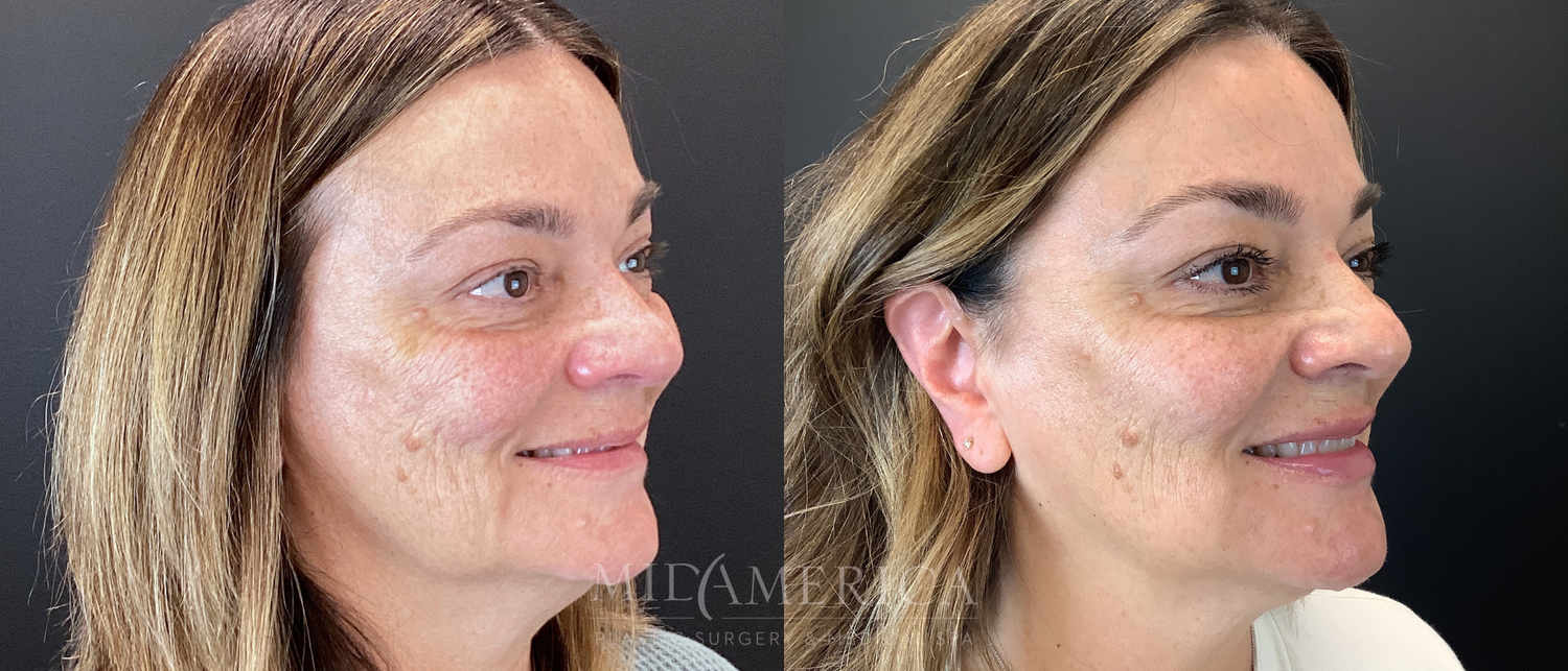 Sculptra Before & After