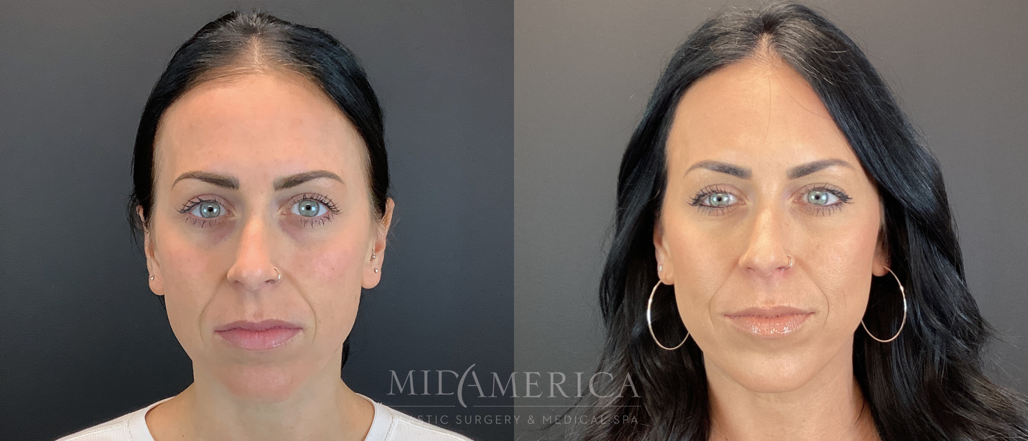 Sculptra Before & After