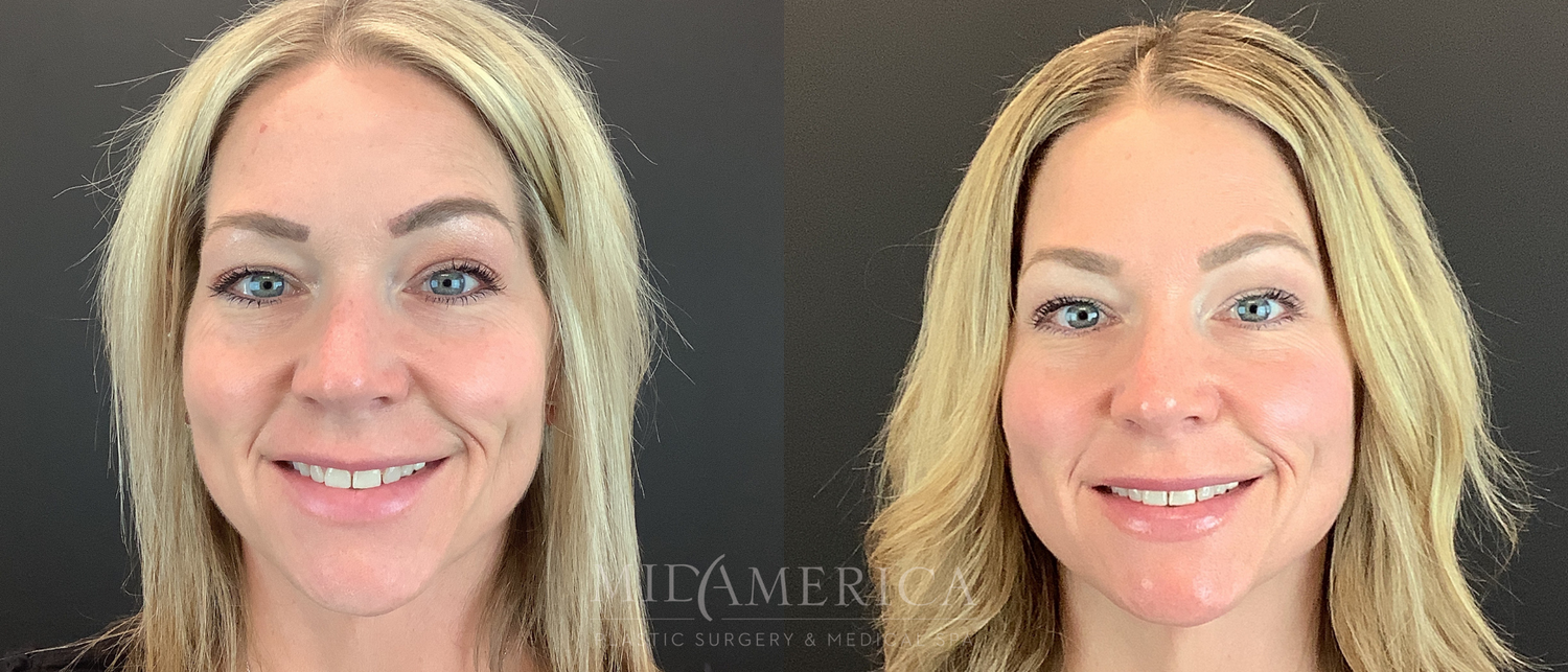 Sculptra Before & After