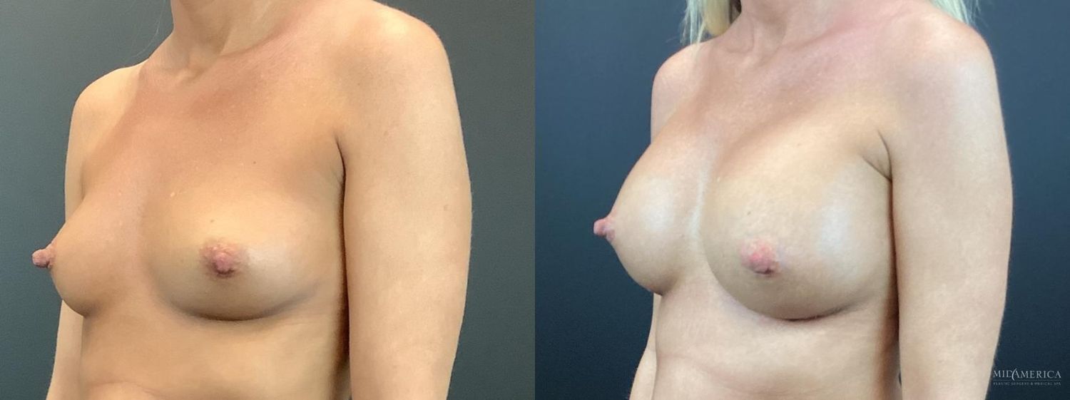Breast Augmentation Before & After