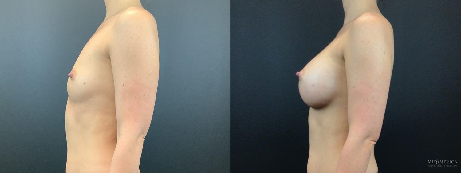 Breast Augmentation Before & After