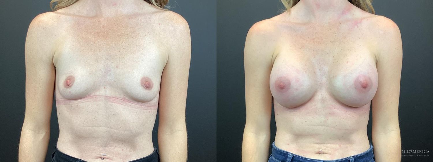 Breast Augmentation Before & After