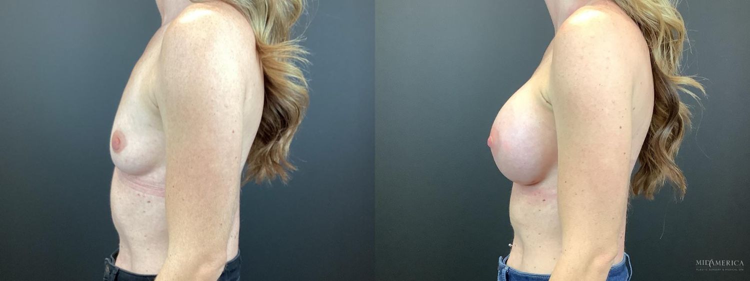 Breast Augmentation Before & After