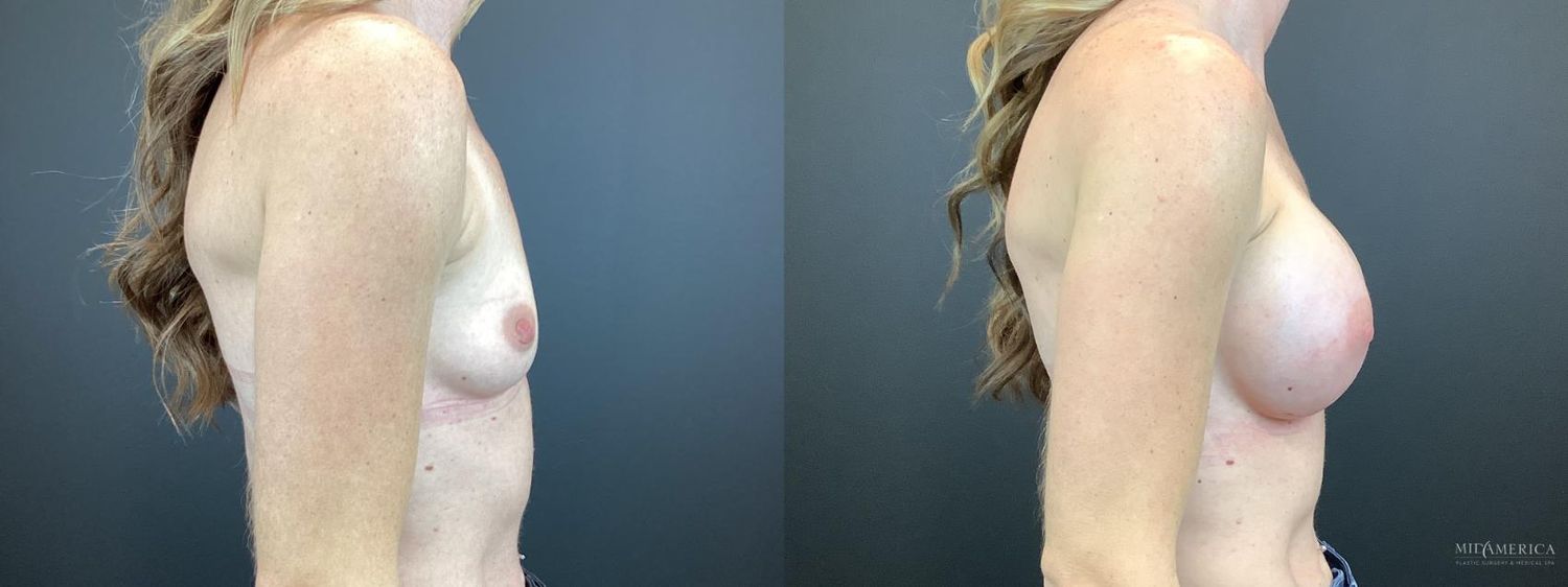 Breast Augmentation Before & After