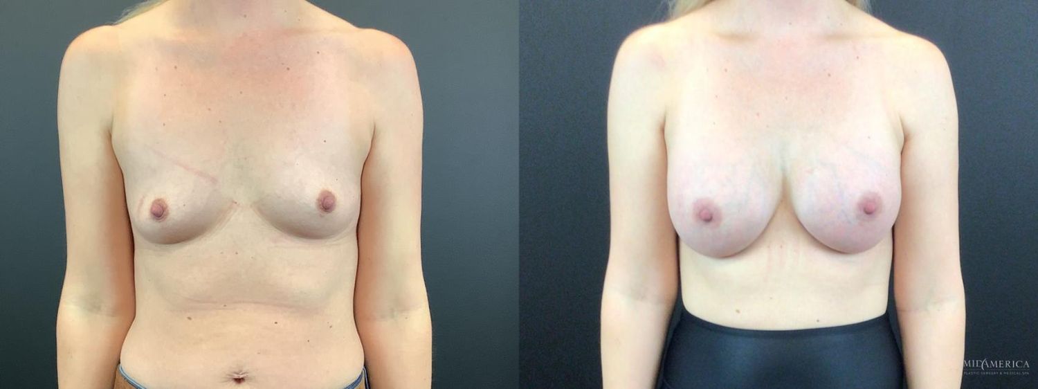 Breast Augmentation Before & After