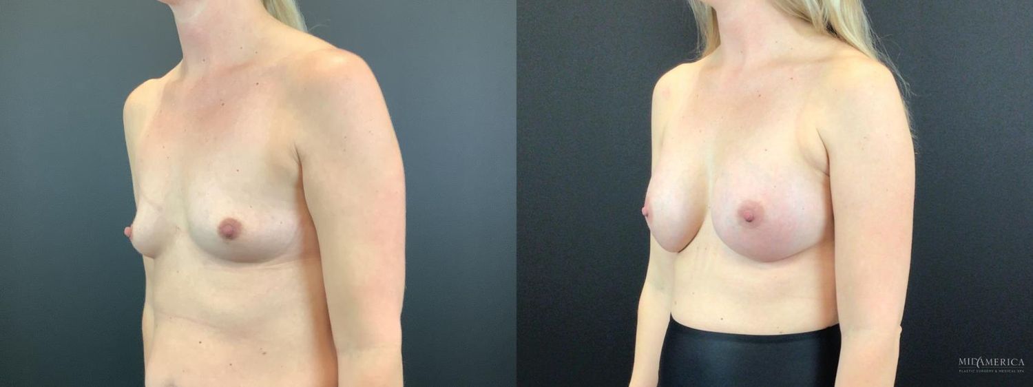 Breast Augmentation Before & After