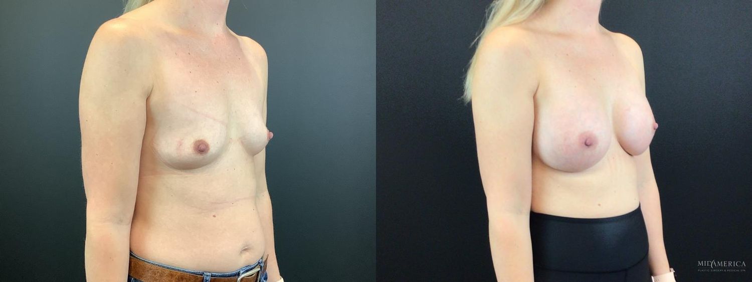 Breast Augmentation Before & After
