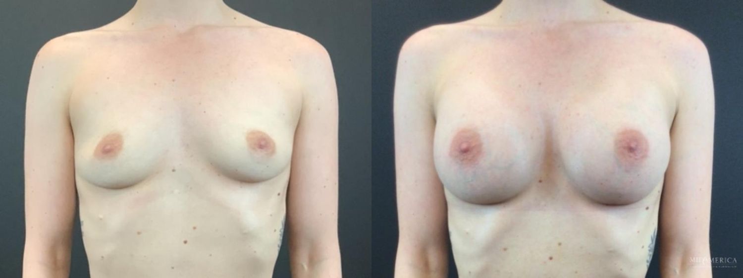 Breast Augmentation Before & After