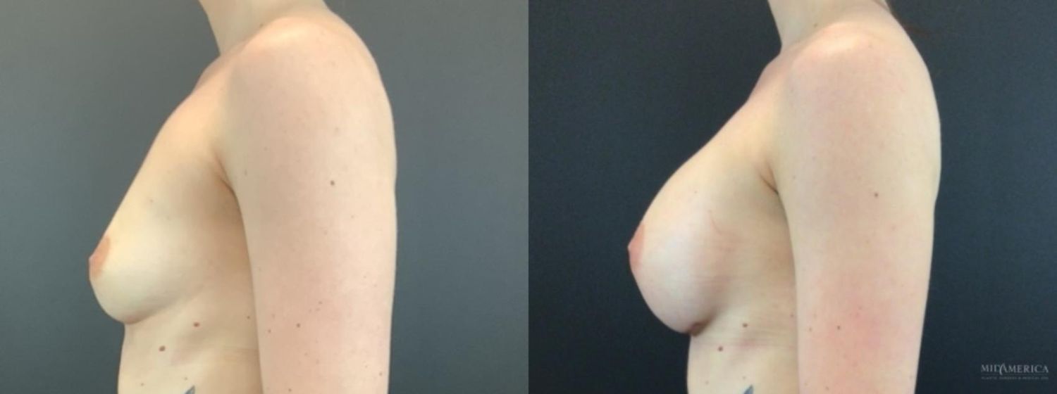 Breast Augmentation Before & After