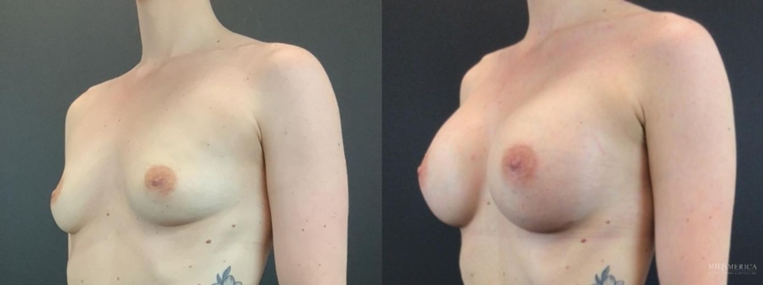 Breast Augmentation Before & After