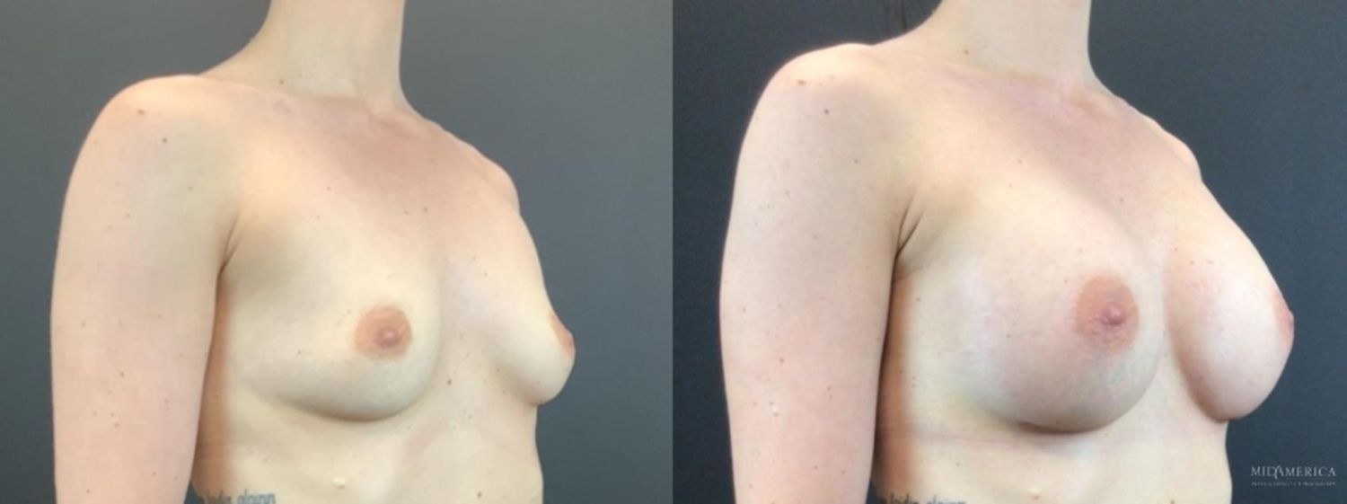 Breast Augmentation Before & After