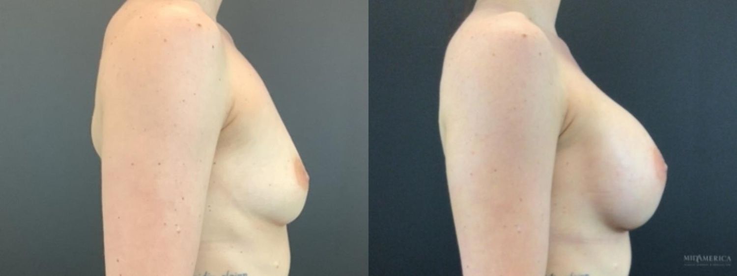 Breast Augmentation Before & After