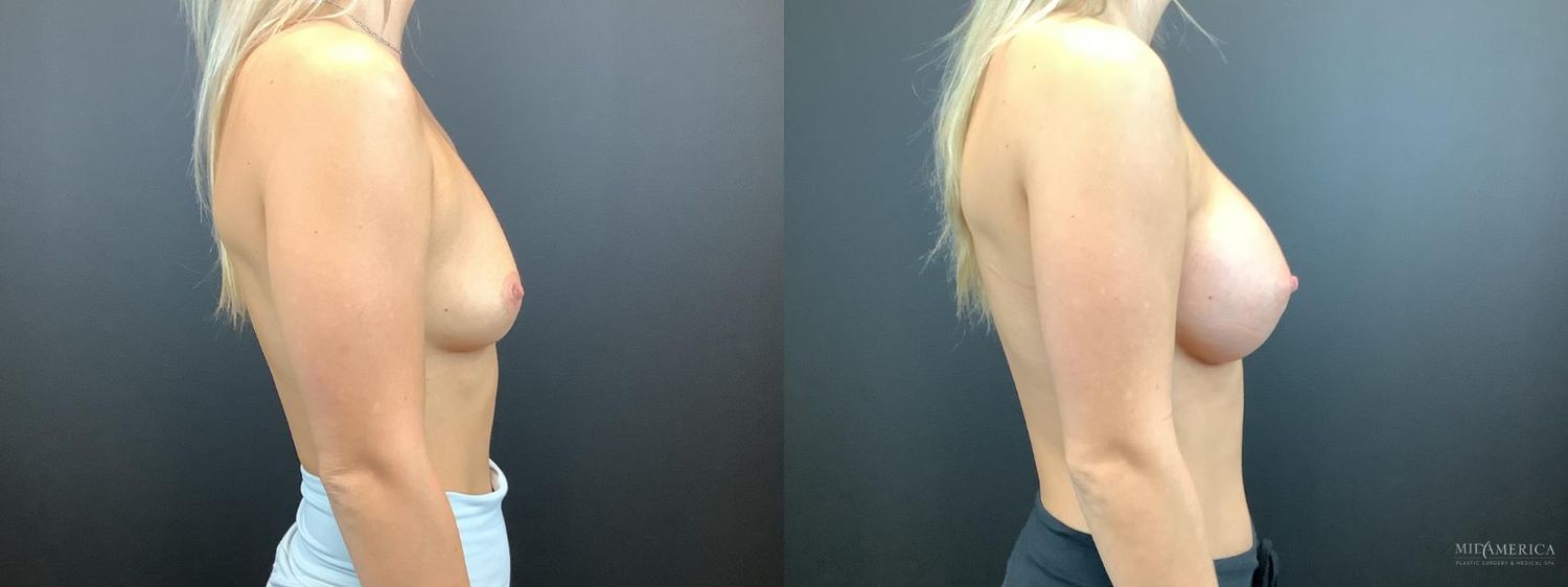 Breast Augmentation Before & After