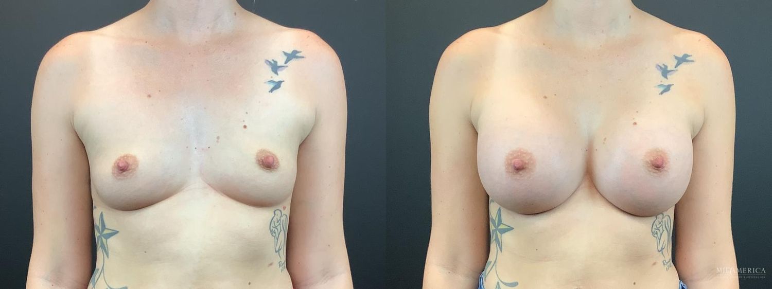 Breast Augmentation Before & After
