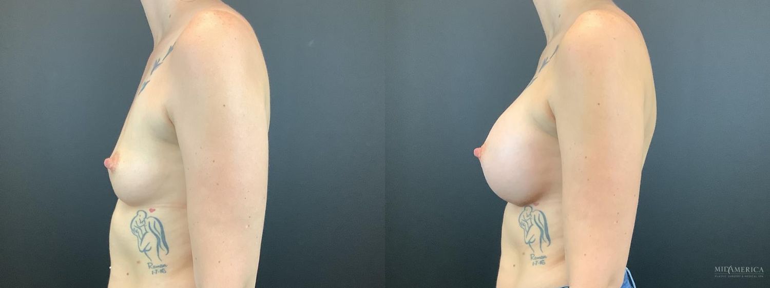 Breast Augmentation Before & After