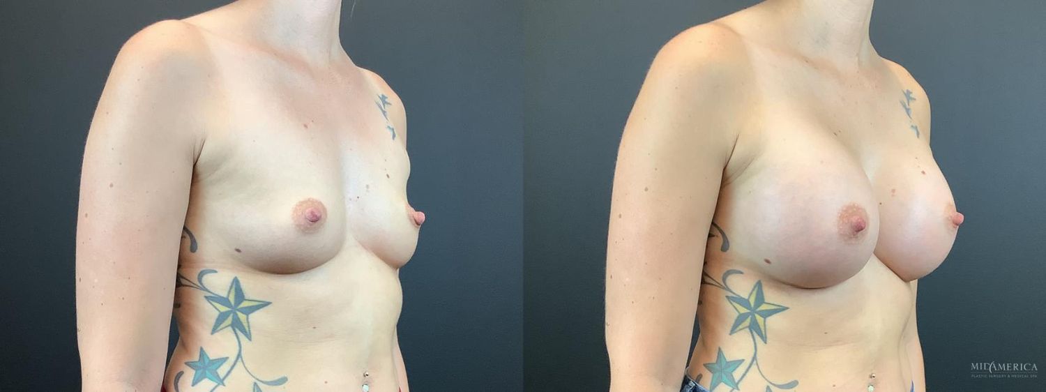 Breast Augmentation Before & After