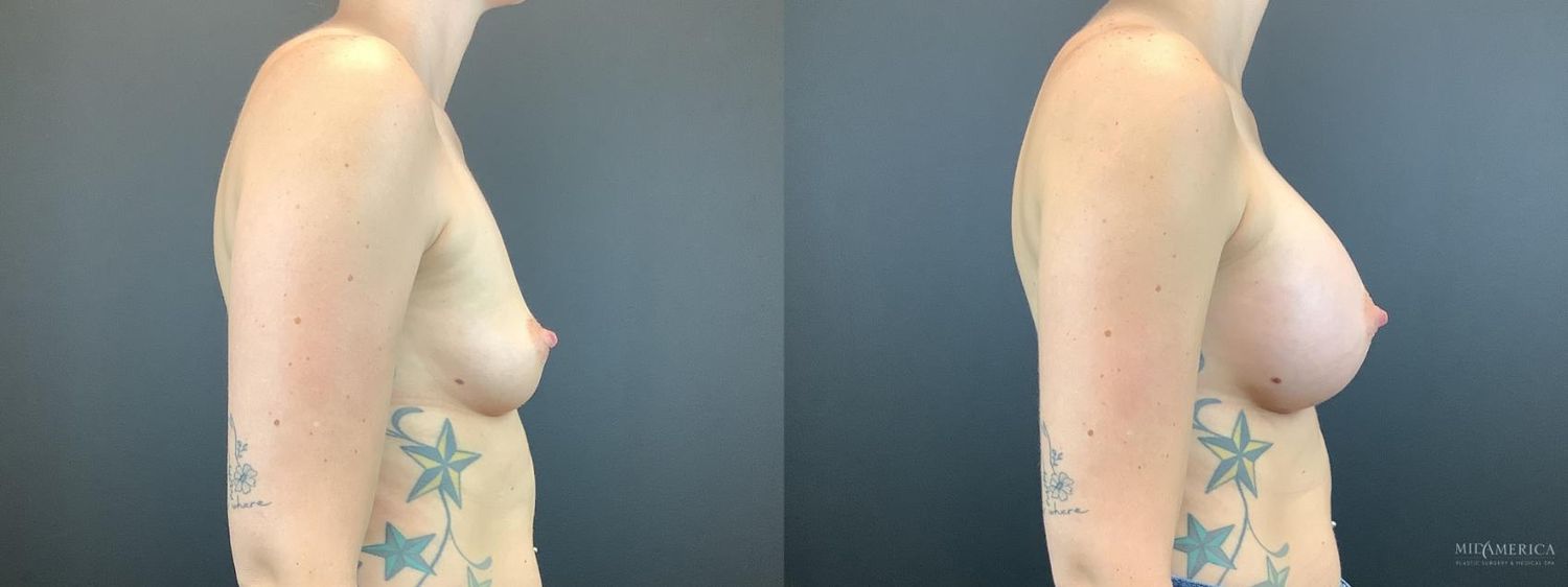 Breast Augmentation Before & After