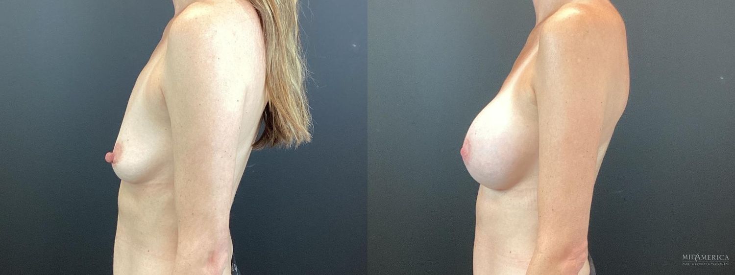 Breast Augmentation Before & After