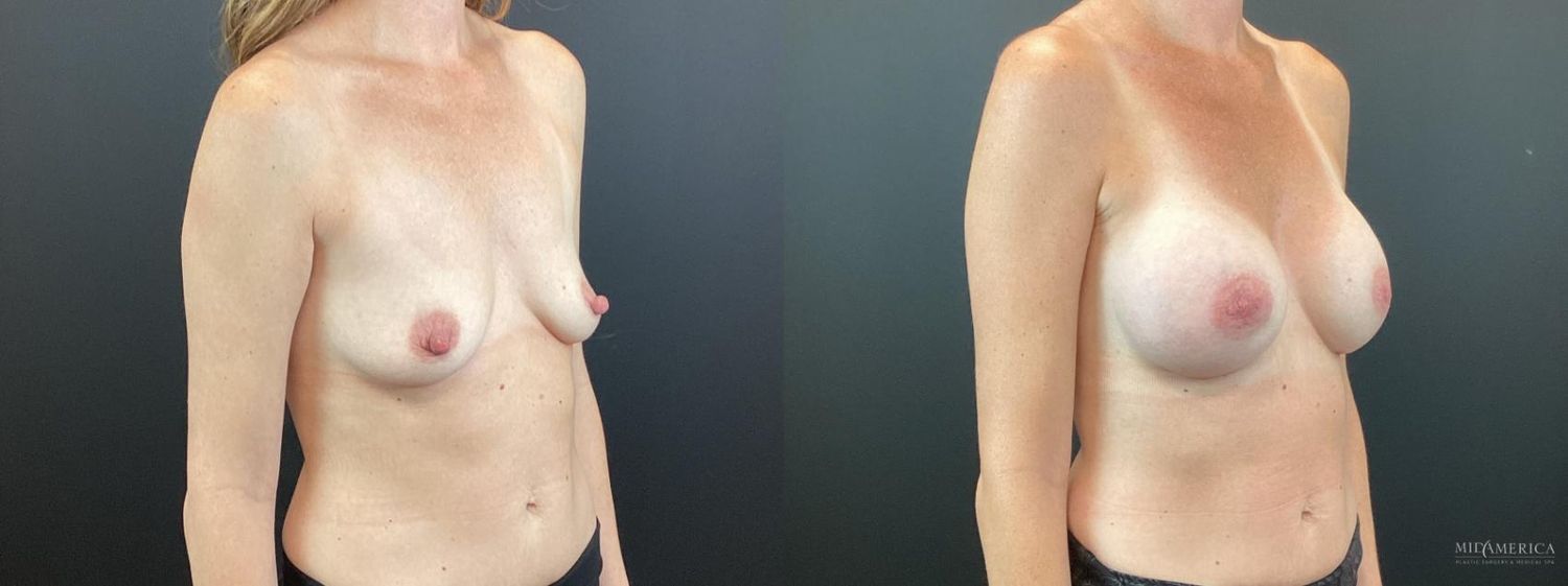 Breast Augmentation Before & After