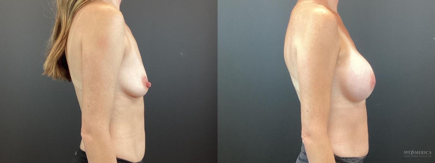 Breast Augmentation Before & After