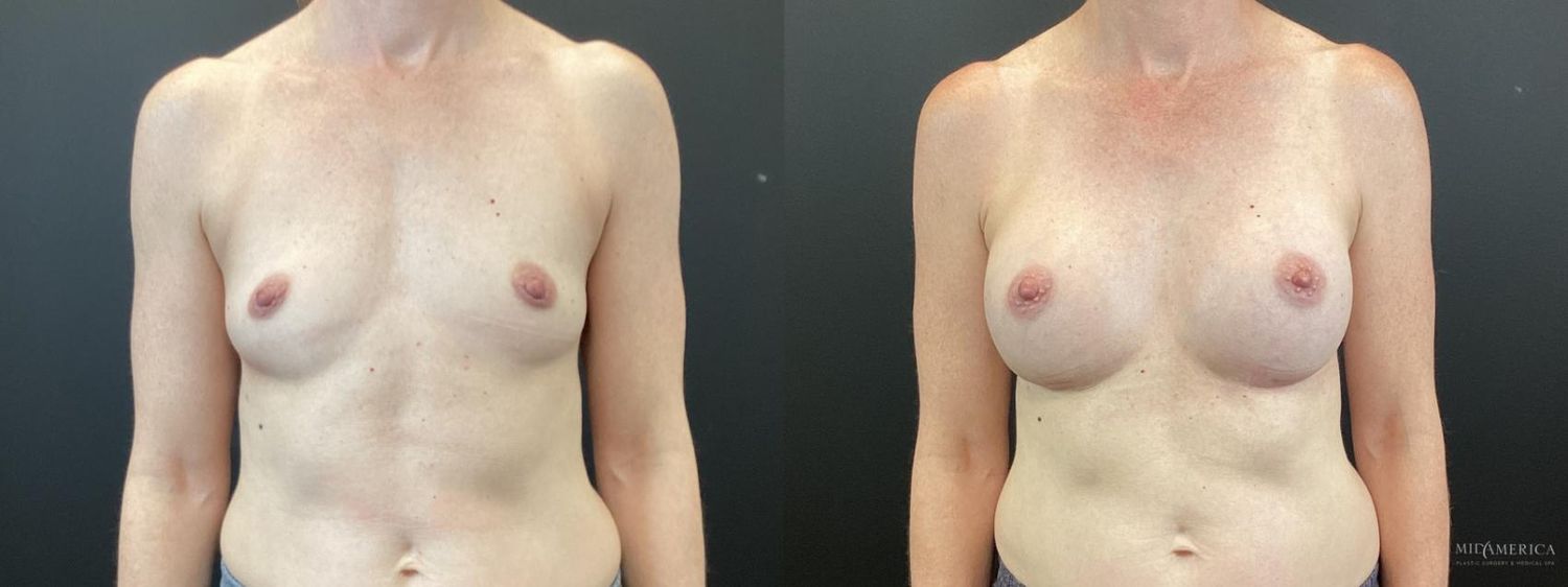 Breast Augmentation Before & After