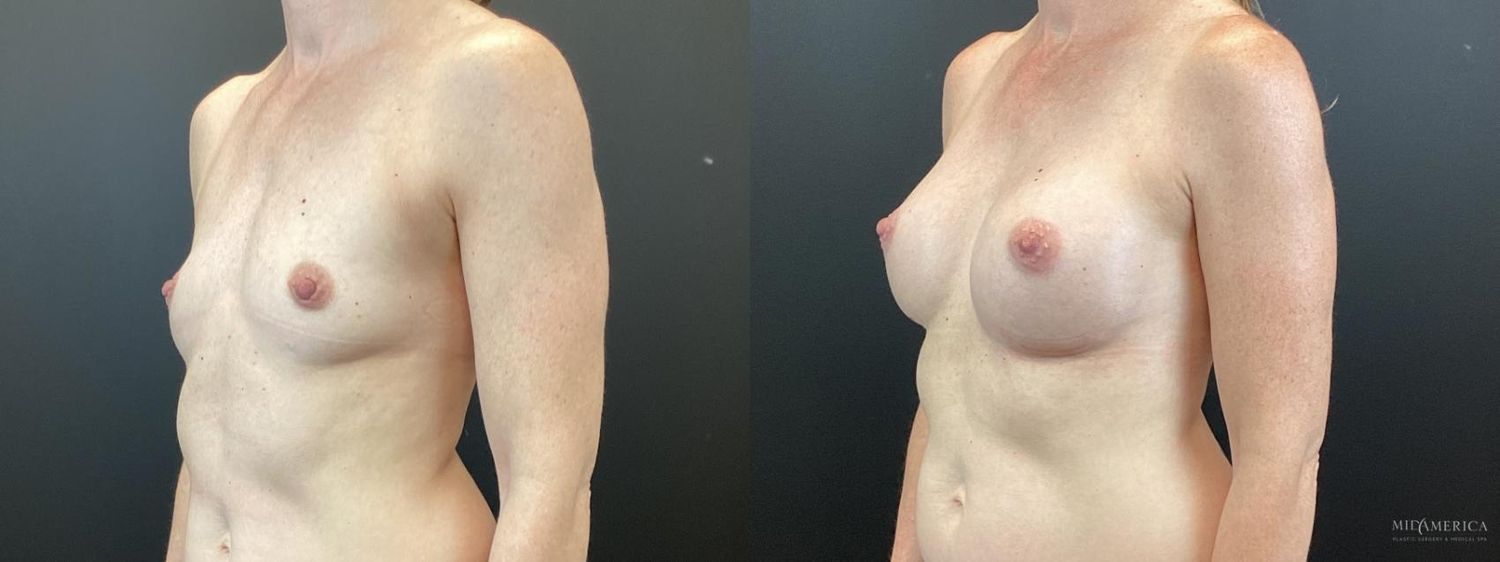 Breast Augmentation Before & After