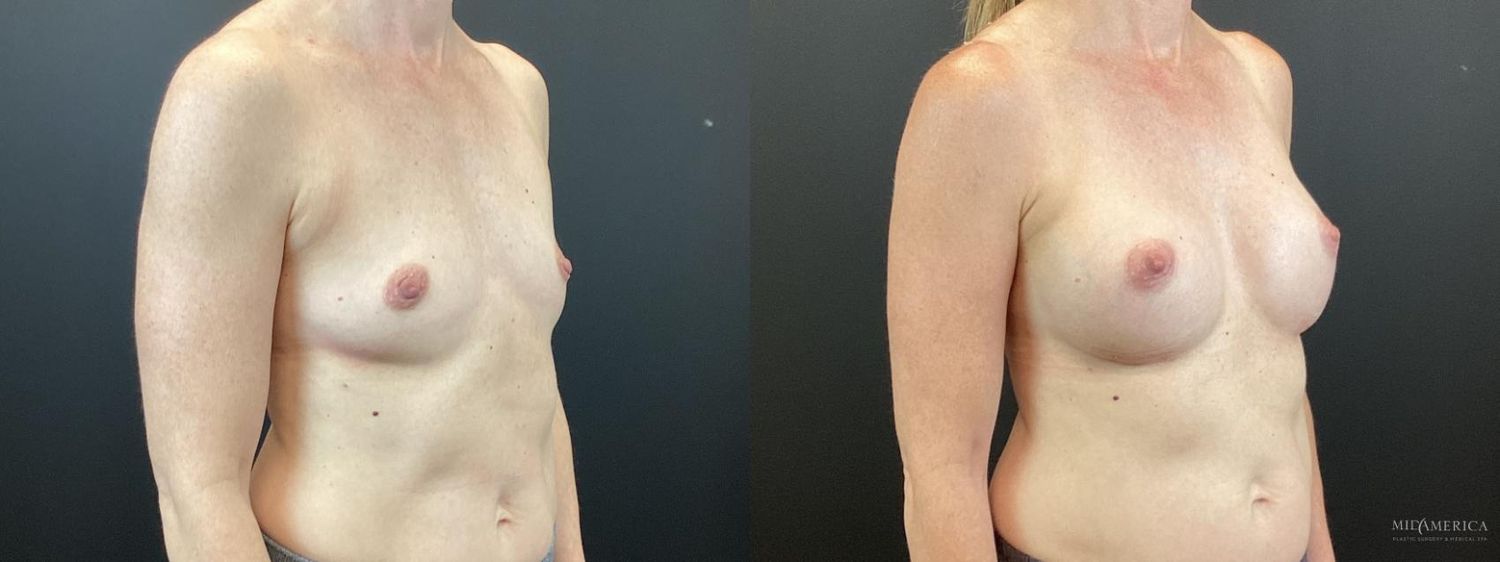 Breast Augmentation Before & After