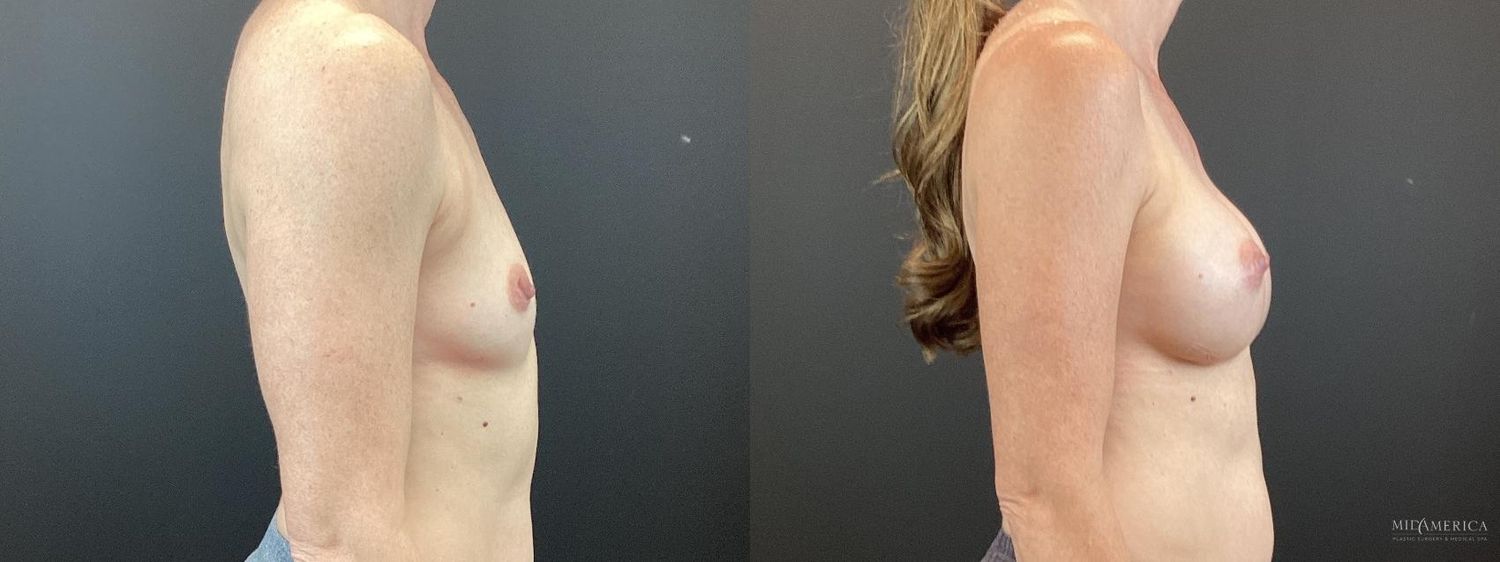Breast Augmentation Before & After
