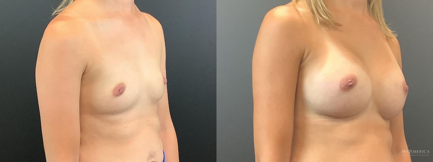 Breast Augmentation Before & After