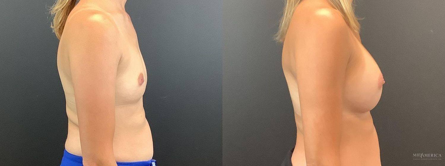 Breast Augmentation Before & After