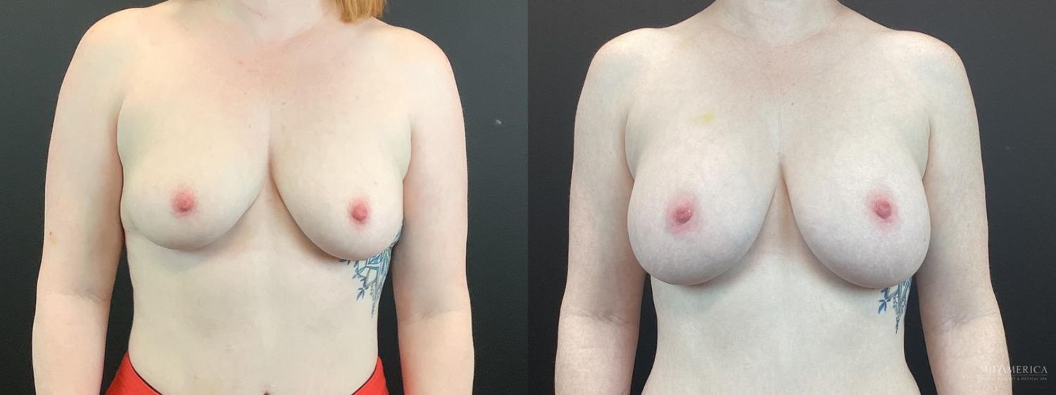 Breast Augmentation Before & After
