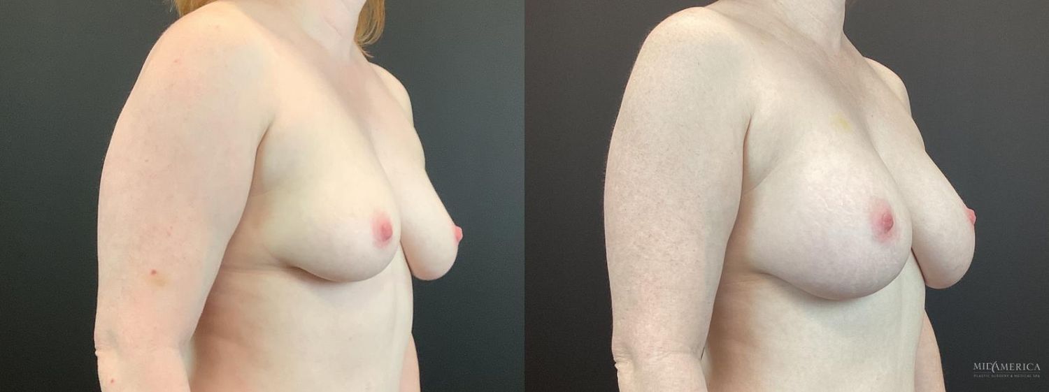 Breast Augmentation Before & After