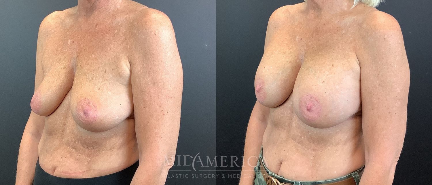 Breast Augmentation Before & After