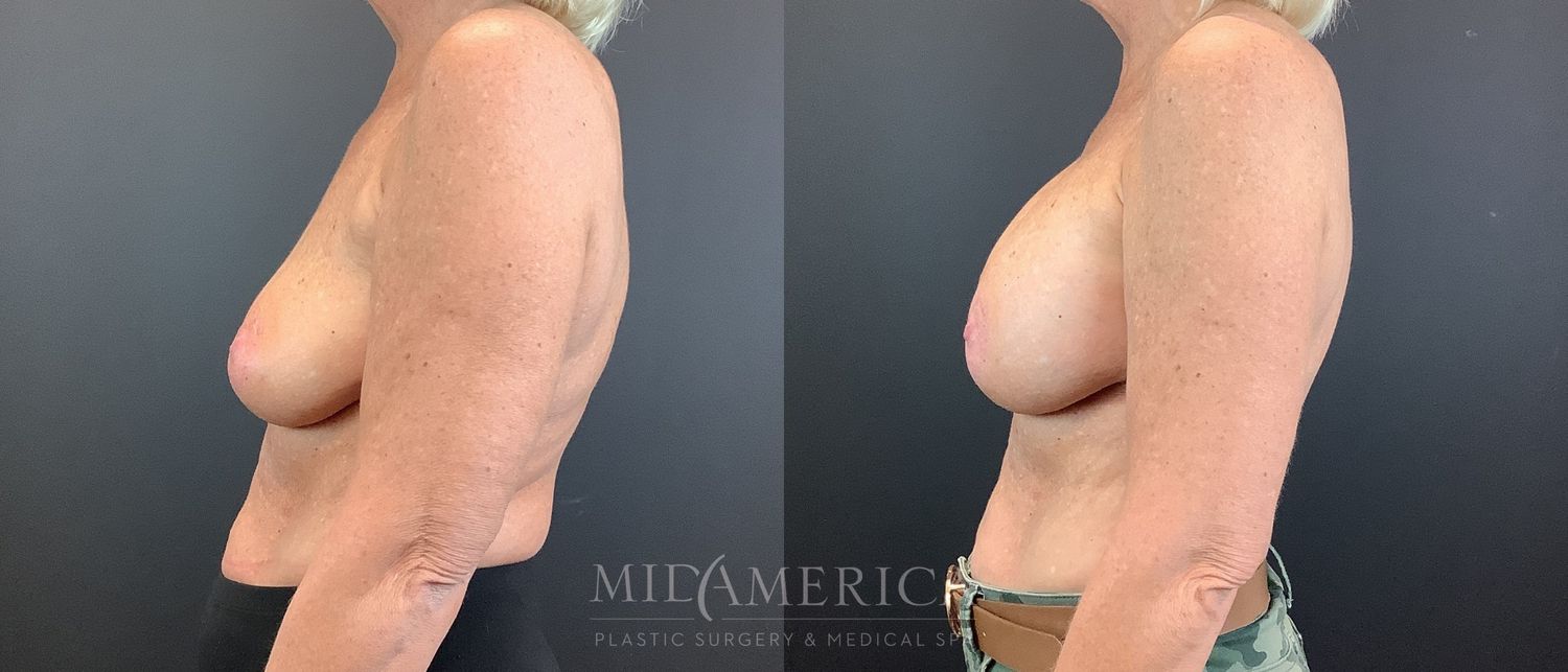 Breast Augmentation Before & After