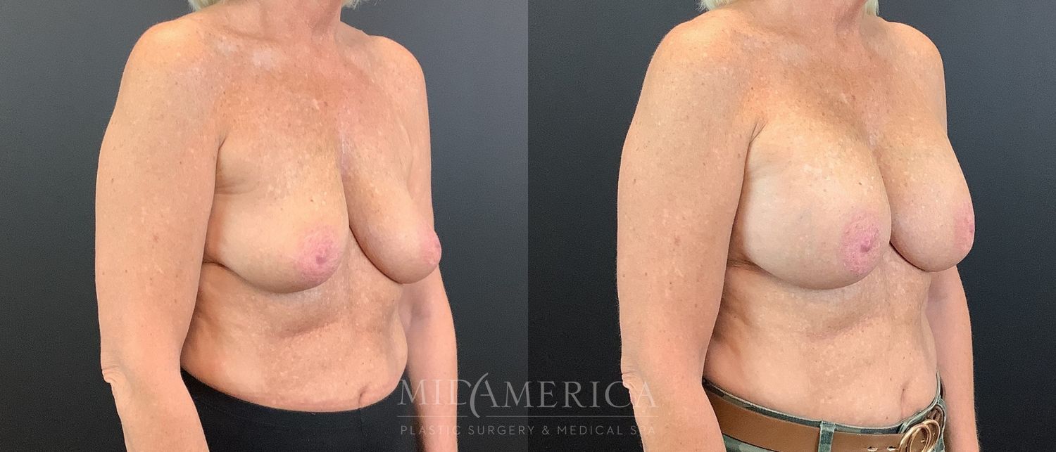 Breast Augmentation Before & After