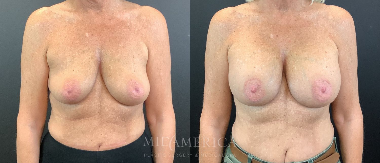 Breast Augmentation Before & After