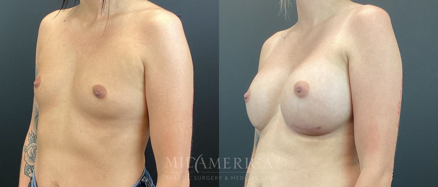 Breast Augmentation Before & After