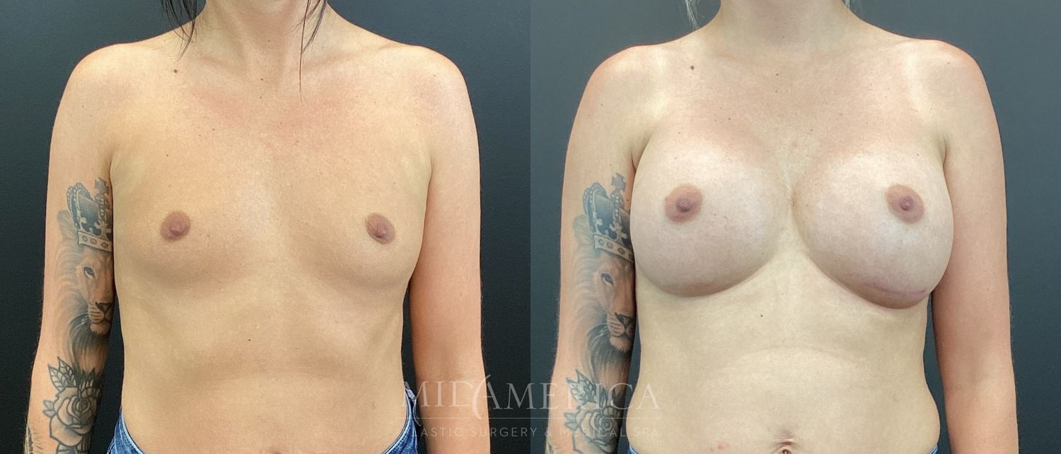Breast Augmentation Before & After